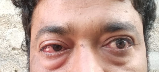 కళ్లకలక కలవరం..!