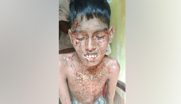 ఊడుతున్న చర్మం చూస్తే భయానకం