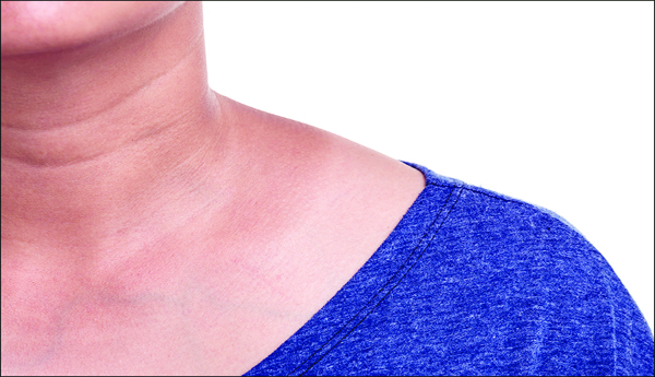 Does-the-sun-turn-the-neck-black