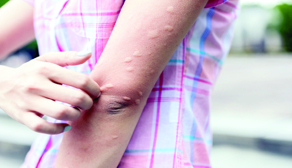 Prevent-fungal-infections