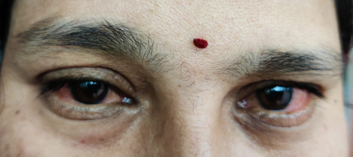 కలవరపెడుతున్న కళ్లకలక