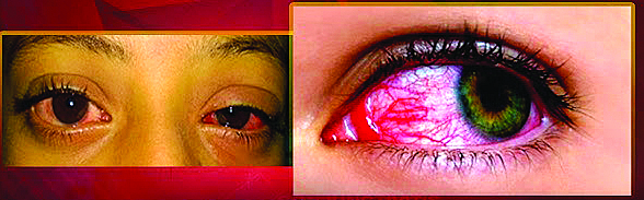 కళ్ల 'కలక'లం..!