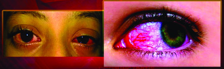 కళ్లకలక పట్ల అప్రమత్తత అవసరం